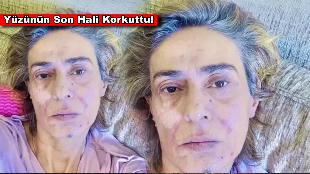 Yıldız Tilbe'den hayranlarını endişelendiren fotoğraf! Yüzünün son hali korkuttu!