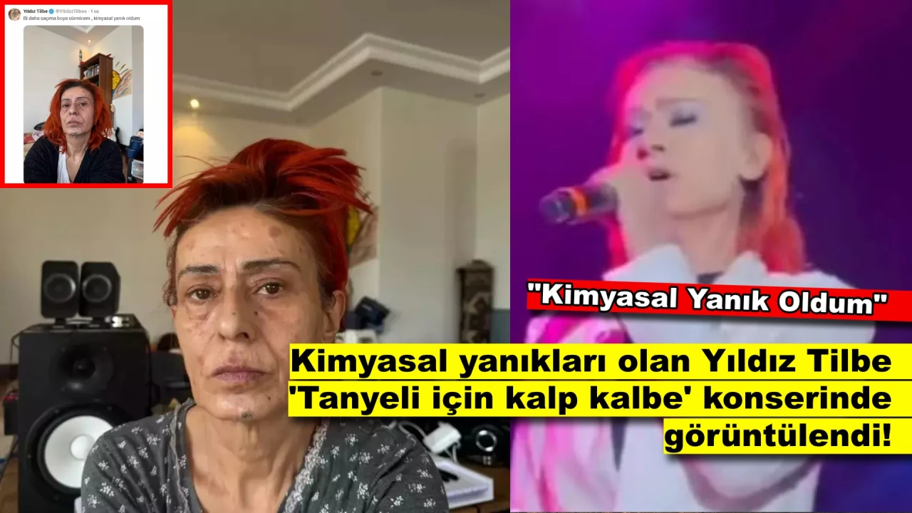 Yüzünde Kimyasal Yanıklar Oluşan Yıldız Tilbe'nin Son Hali Şaşırttı!