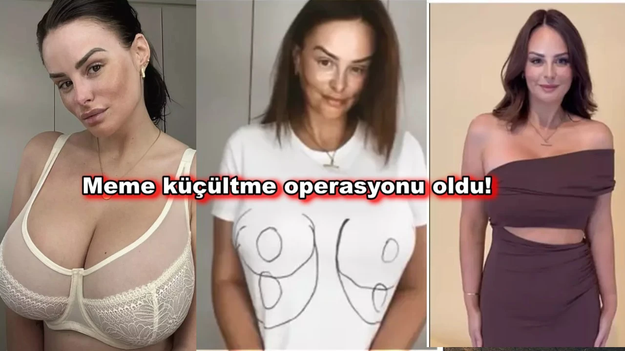 Göğüs uçları 11 cm aşağıda olan model meme küçültme ameliyatı oldu!