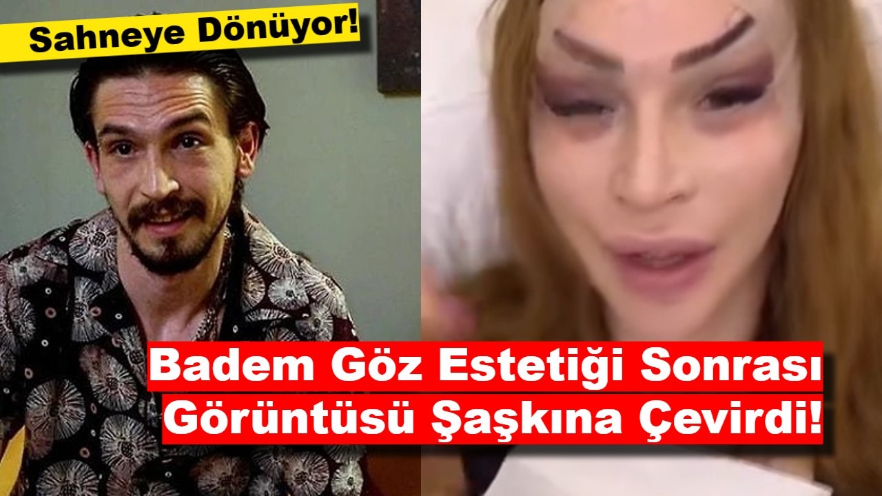 Badem Göz Estetiği Sonrası Görüntüsü Şaşkına Çevirdi!