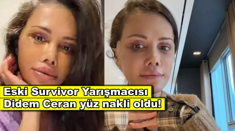 Eski Survivor yarışmacısı Didem Ceran yüz nakli oldu!